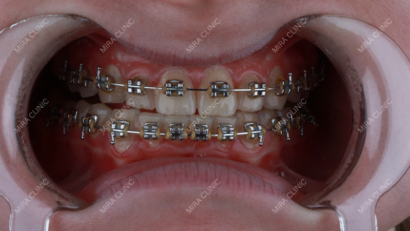 five years of braces
